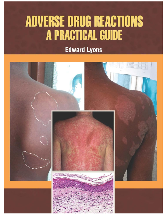 Adverse Drug Reactions A Practical Guide